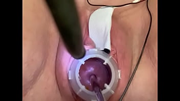 Painful electrosounding cervix