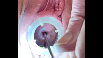 Deep cervical os dilation w painful sound