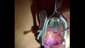 Inserção de tenáculo sadio no colo do útero