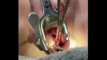 Segurando o tenáculo do colo do útero enquanto o dilatador mm fode o útero